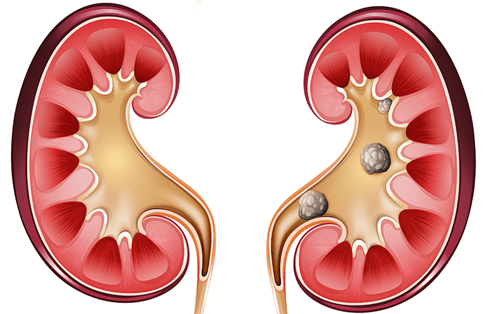 Los mejores tratamientos para el cálculo renal con el Dr. Ismael Almaraz Ortiz