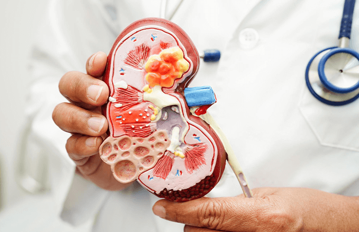 Cáncer renal