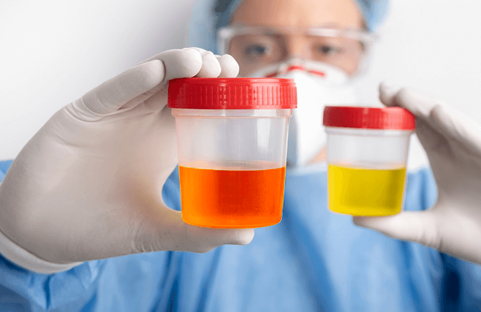 Hematuria o sangre en la orina ofrecido por Dr. Ismael Almaraz Ortiz